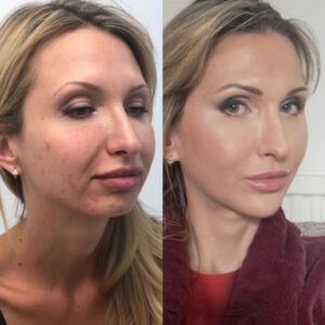 Profiloplasty 1