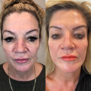 Profiloplasty 2