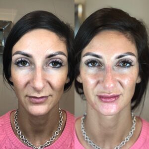 Profiloplasty 3