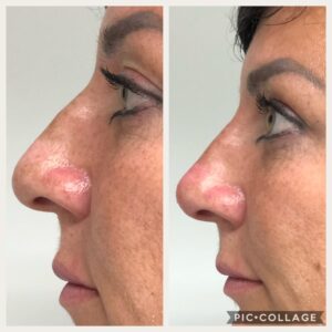 Rhinoplasty 3