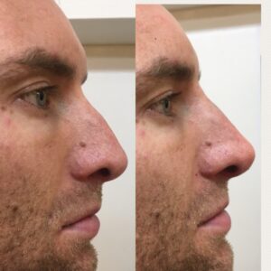 Rhinoplasty 4