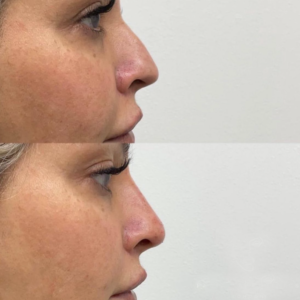 Rhinoplasty 7