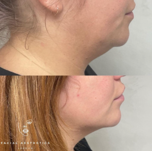 aqualyx fat 2