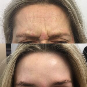 botox 1