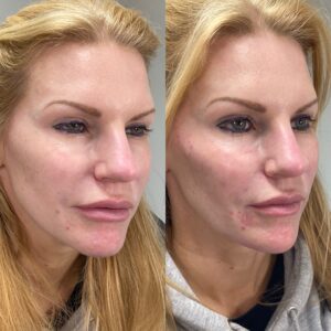 cheek enhancement 1