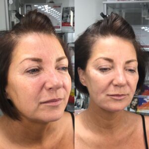 cheek enhancement 2