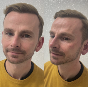 cheek enhancement 3