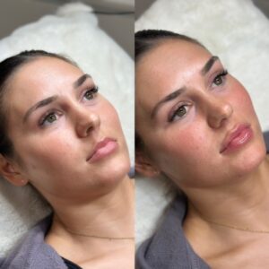 dermal fillers 1