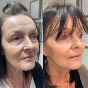 dermal fillers 2