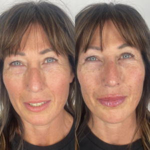 dermal fillers 3
