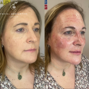 dermal fillers 4