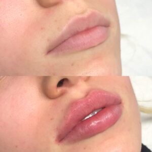 lip enhancement 1