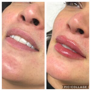 lip enhancement 3