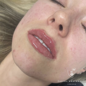 lip enhancement 4