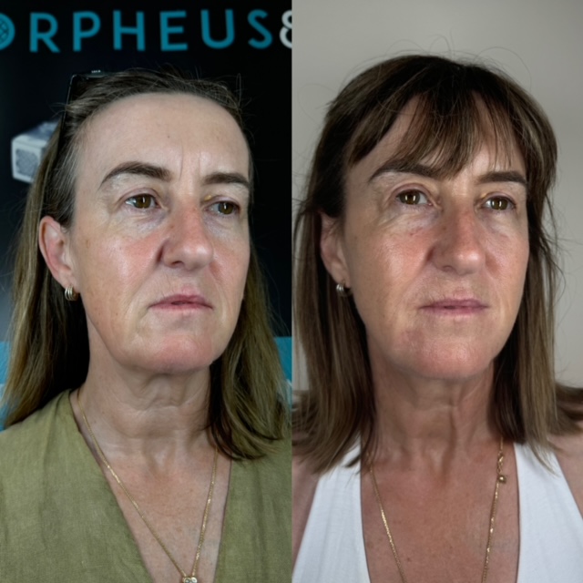 Morpheous slide image 3