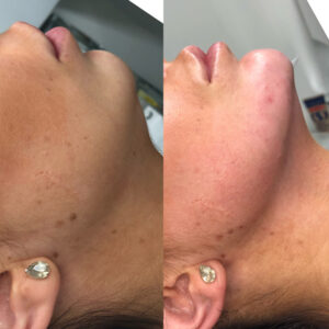Non-Surgical Jaw Reduction 1